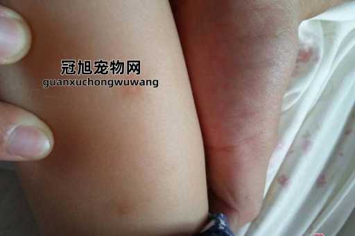 被蚊子咬了后出现白色斑点(需要看医生吗)