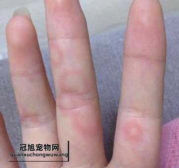 被蚊子咬了后出现白色斑点(需要看医生吗)