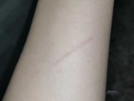猫挠出血不打针有事吗(万一感染了狂犬病怎么办)
