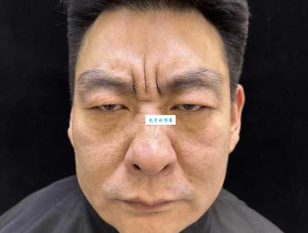 川字纹太显老怎么办？教你轻松去除川字纹！