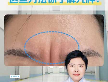 川字纹太显老怎么办？教你轻松去除川字纹！