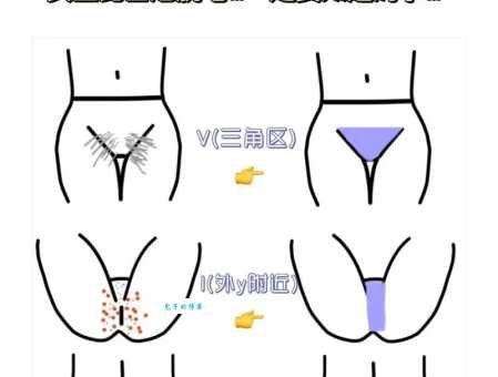 比基尼脱毛形状推荐这几种最好看还显瘦